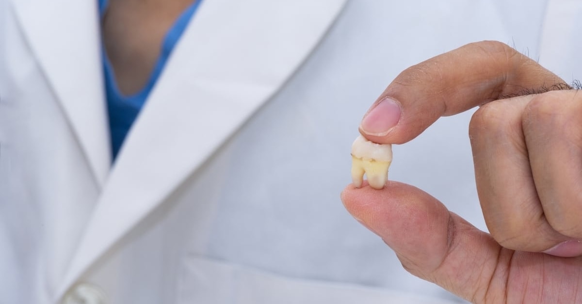 Generic image of oral health specialist holding a wisdom tooth