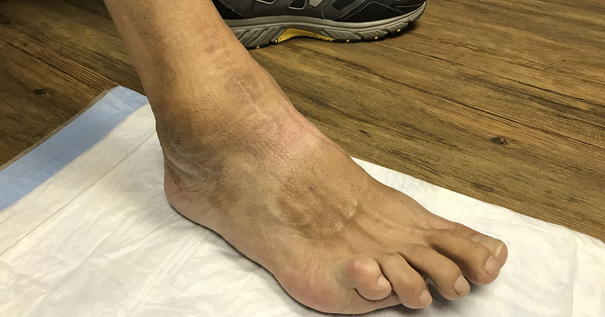 Joe Dugan's foot after total ankle replacement surgery performed by Jason George DeVries DPM