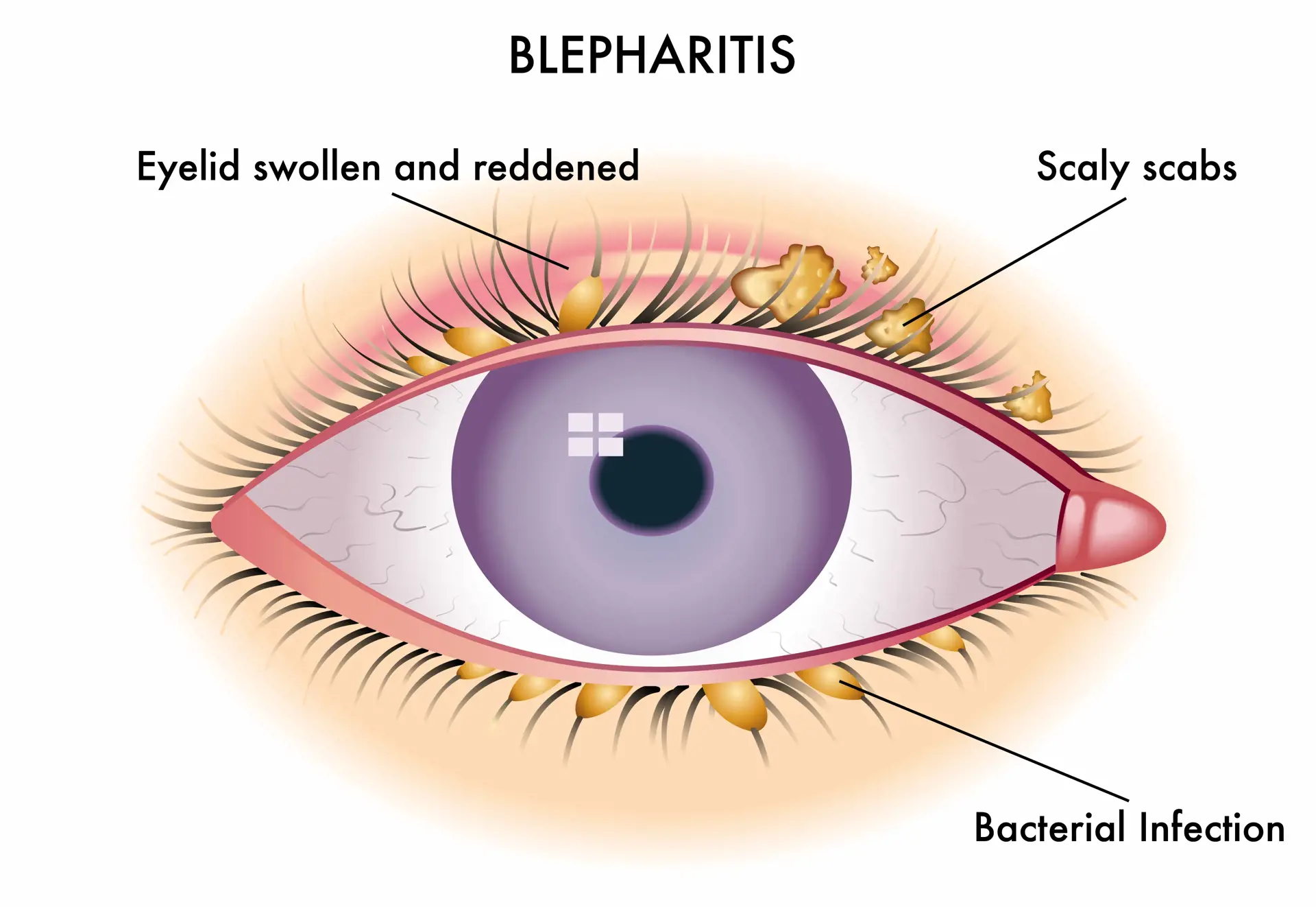 Blepharitis