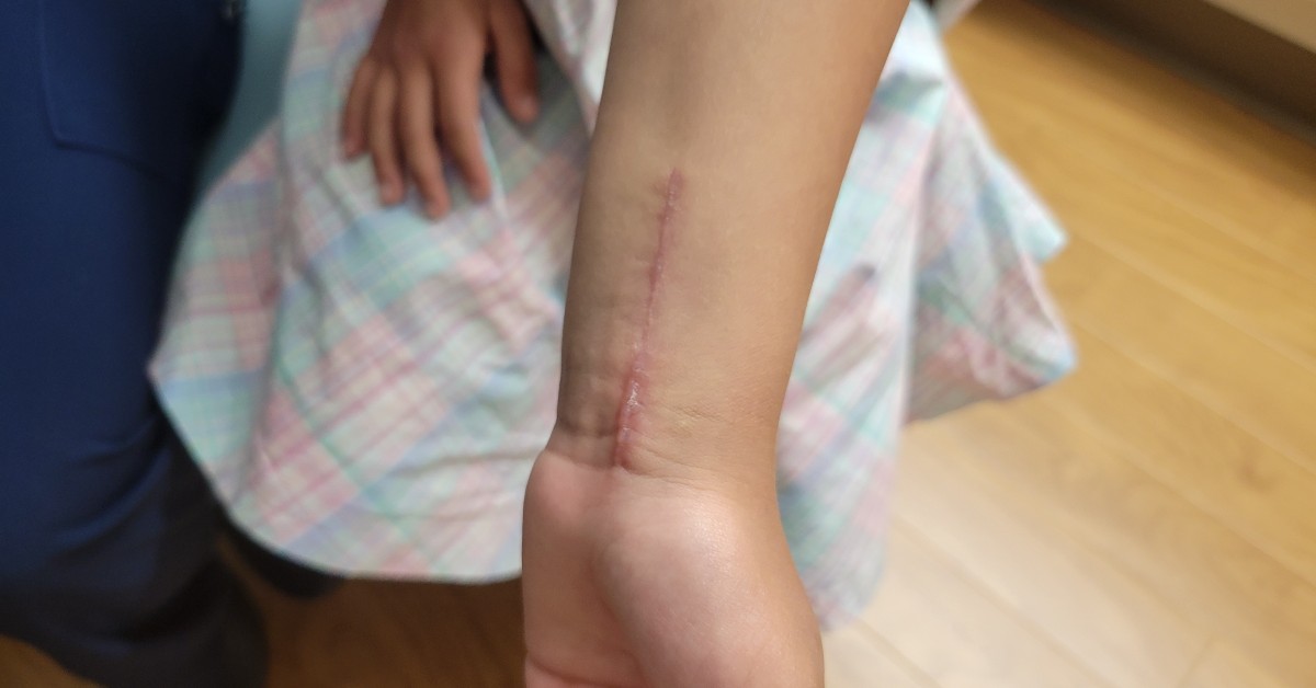 Wrist surgery scar on young girls arm