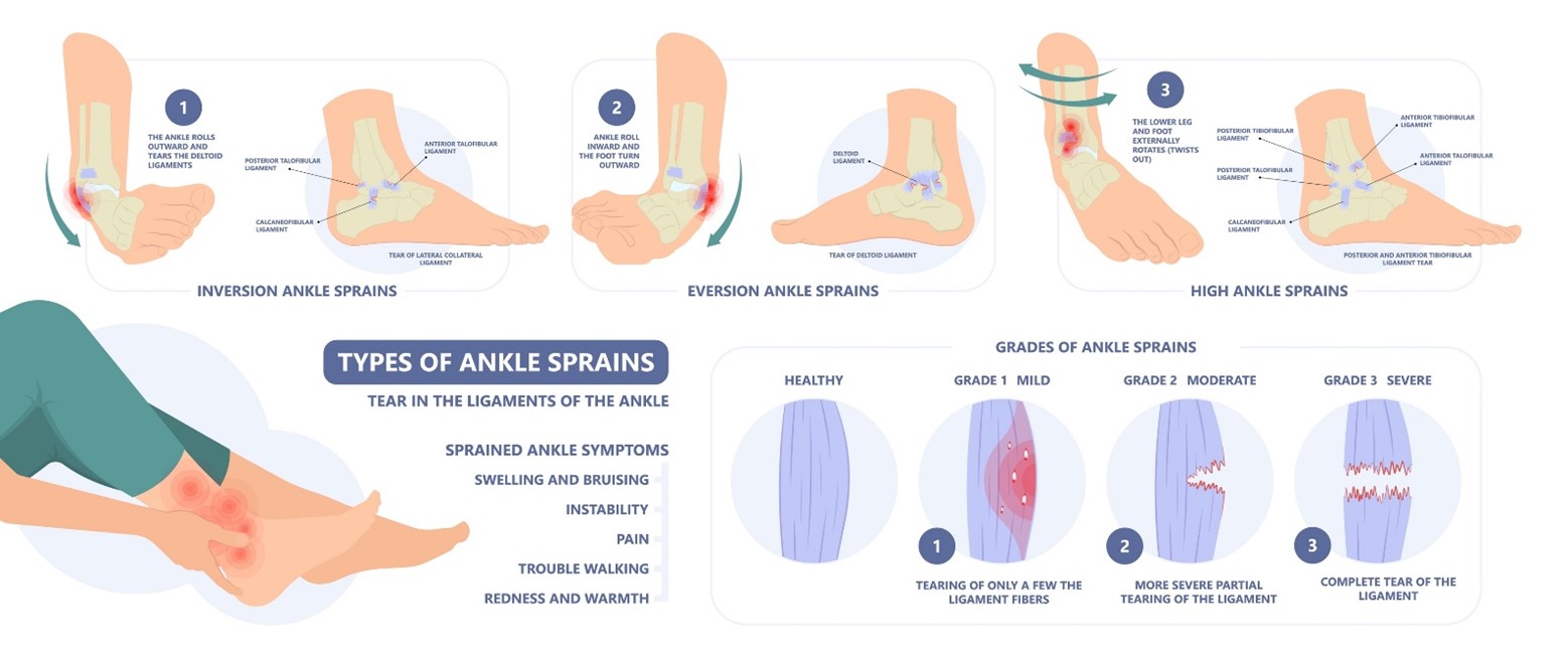 Types and severity grades of ankle sprains