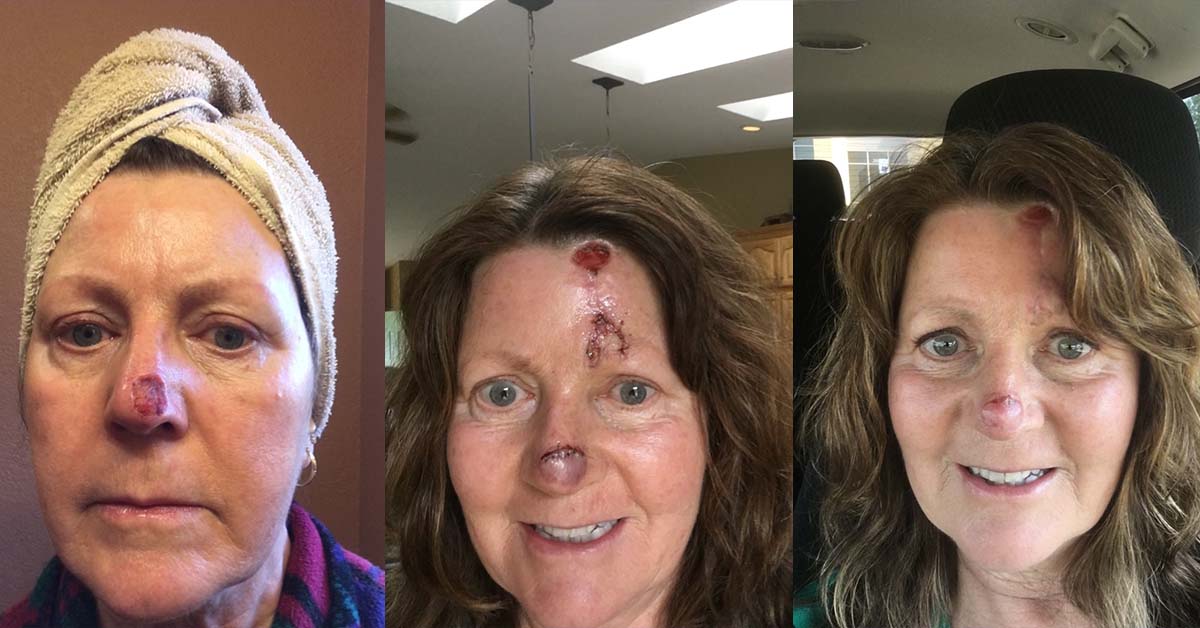 Lori Ravnikar, a patient of Dr. Elizabeth O’Connor of BayCare Clinic, pose for a selfie to show healing process after having surgery.