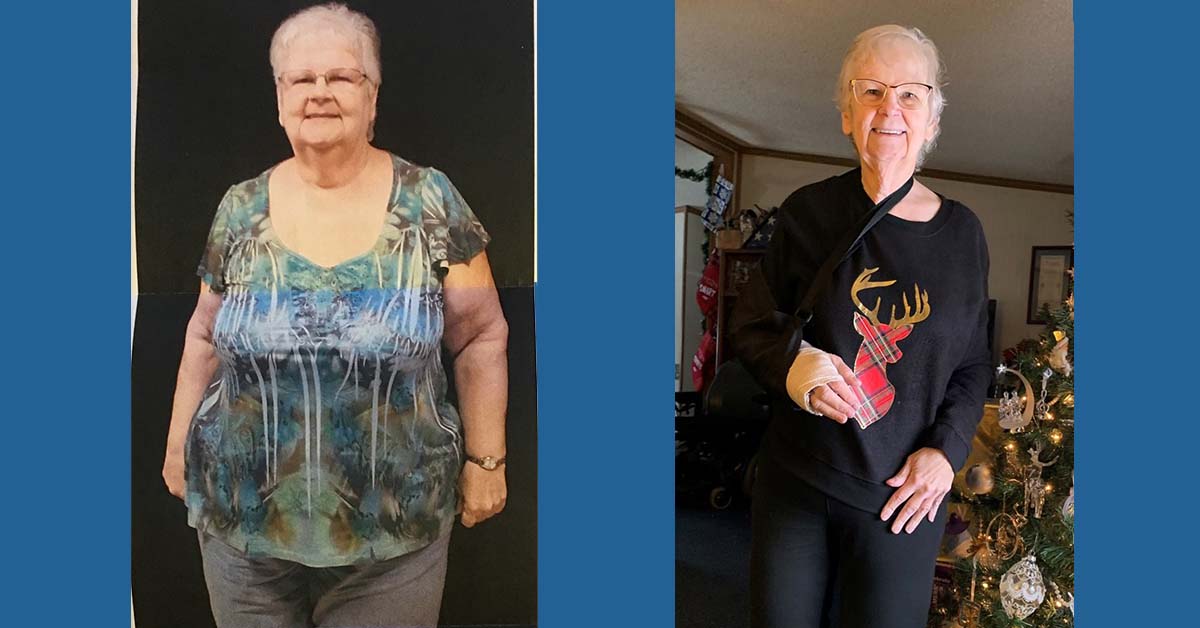 Barbara Wilmot before and after bariatric surgery